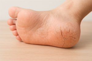 乾燥によるかかとのひび割れ対策|