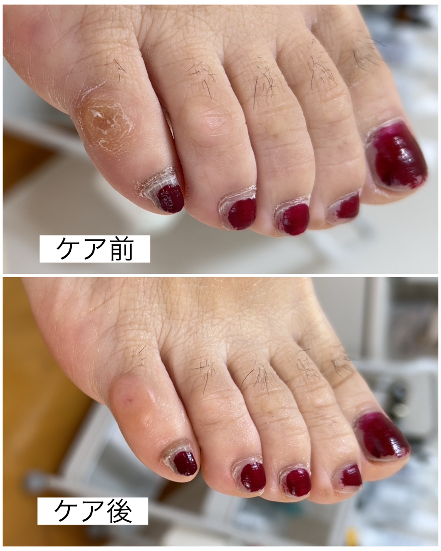 事例紹介【小趾背のウオノメ】