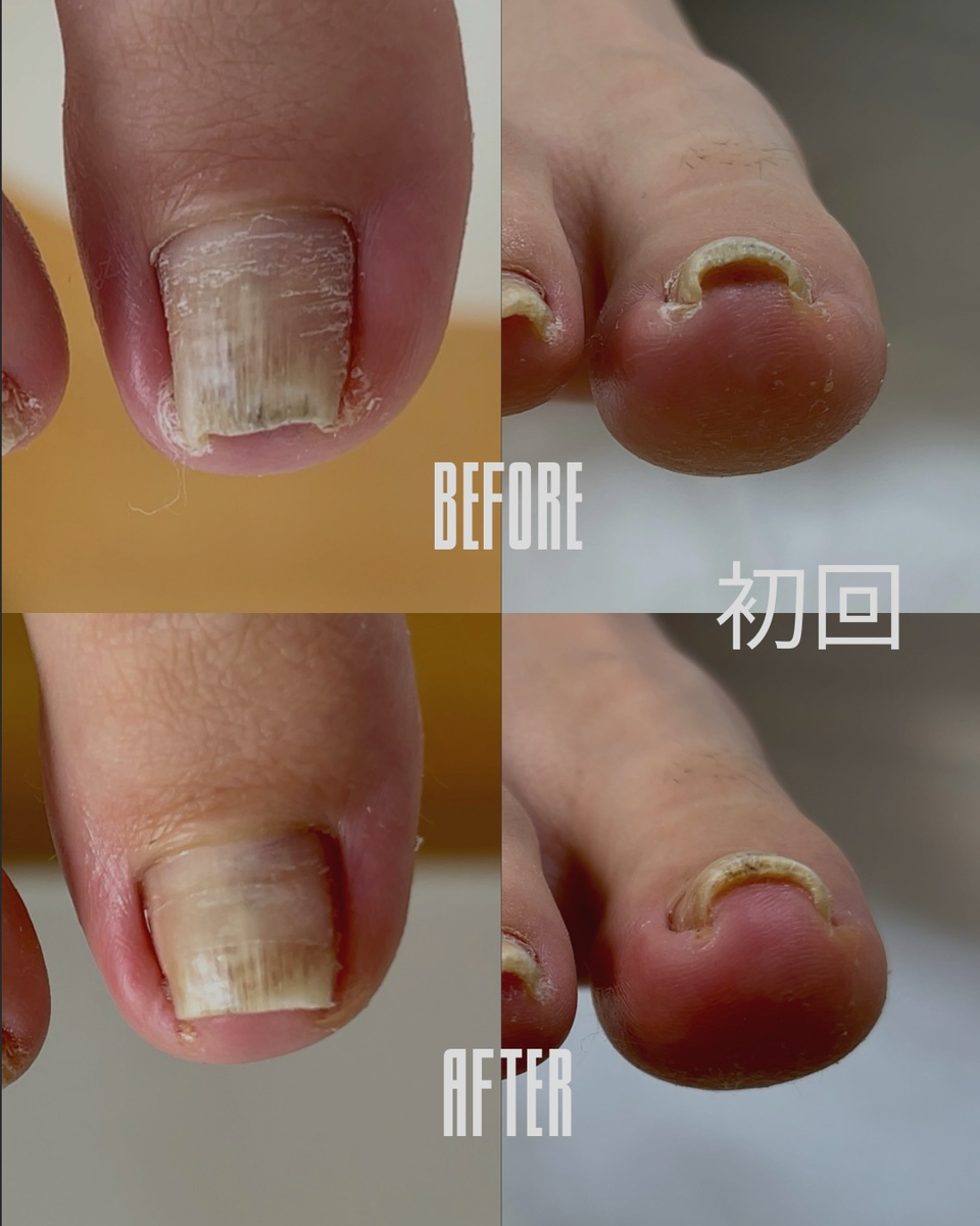 【 巻き爪補正の施術経過 】